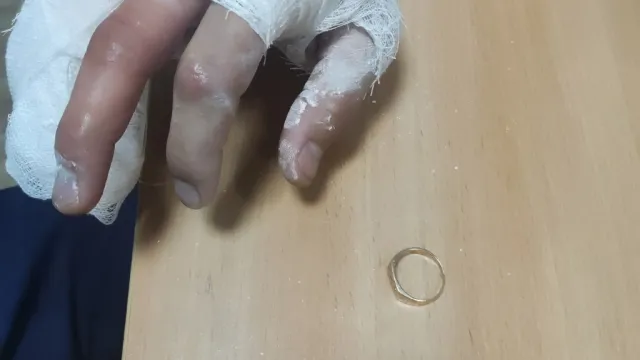 В Астрахани спасатели помогли мужчине снять кольцо со сломанной руки