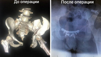 Астраханские врачи спасли жизнь девушке после ДТП на мотоцикле