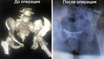 Астраханские врачи спасли жизнь девушке после ДТП на мотоцикле