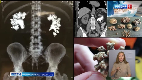 В Астрахани с помощью нового аппарата "Уролит" делают высокотехнологичные операции