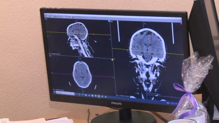 В Астраханской области инсульт ежегодно переносят до 3 тысяч человек
