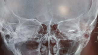 В Астрахани врачи извлекли осколок металла из глаза мужчины