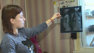 Астраханке со сколиозом 4-й степени помогли выпрямиться в полный рост